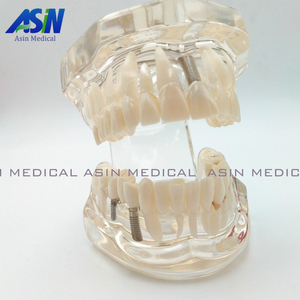 High Quality NEW Arrival Dental Implant Demonstration Bracket