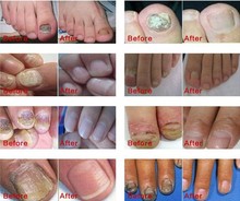 Free shipping AFY 30ML fungal nail treatment essence oil of onychomycosis Repair nails nursing ringworm of
