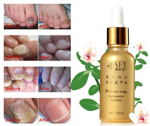 AFY Fungal Nail Treatment TCM Essence Oil Hand and Foot Whitening Toe Nail Fungus Removal Feet Care Nail Tools Nail Gel Polish