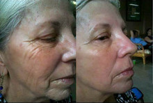 Boto x Instantly Ageless Acid Face Lift Powerful Anti-wrinkle Anti-aging Facial Skin Care Botulinum Concentrate