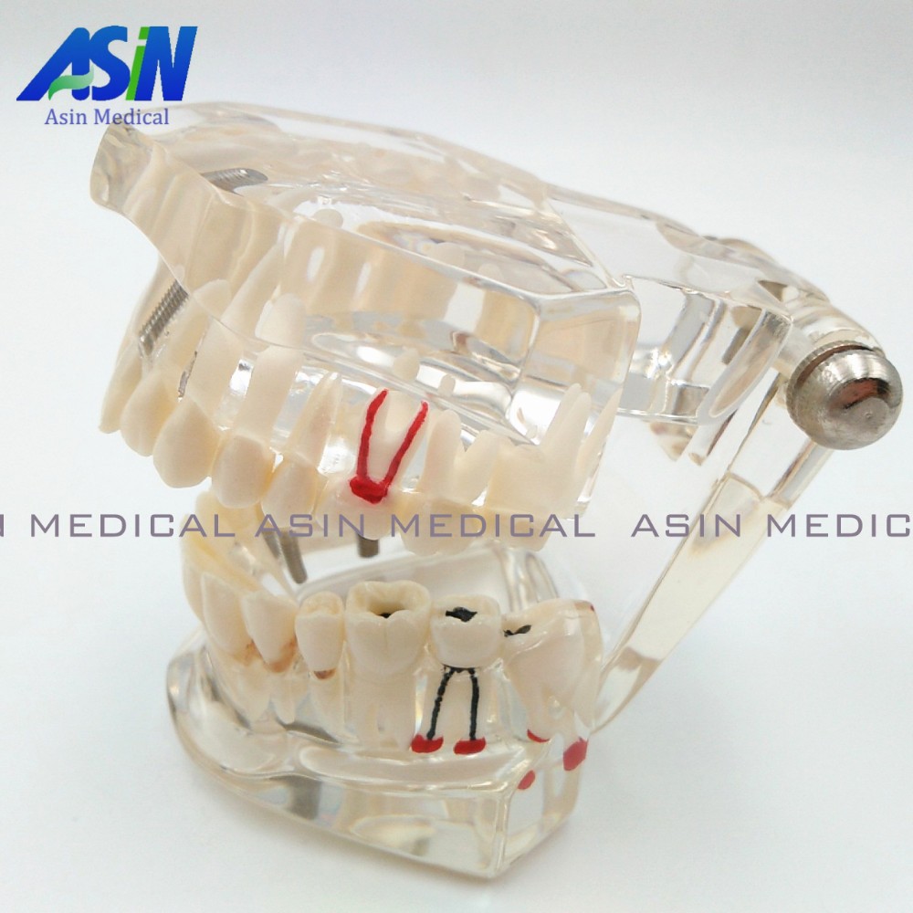 High Quality NEW arrival Dental implant Demonstration Bracket High Quality NEW arrival Dental implant Demonstration Bracket Simulation Caries Teeth Model teeth removable Dentist us826