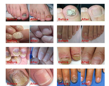 Fungal Nail Treatment Essence Nail and Foot Whitening Toe Nail Fungus Removal Feet Care Nail Gel