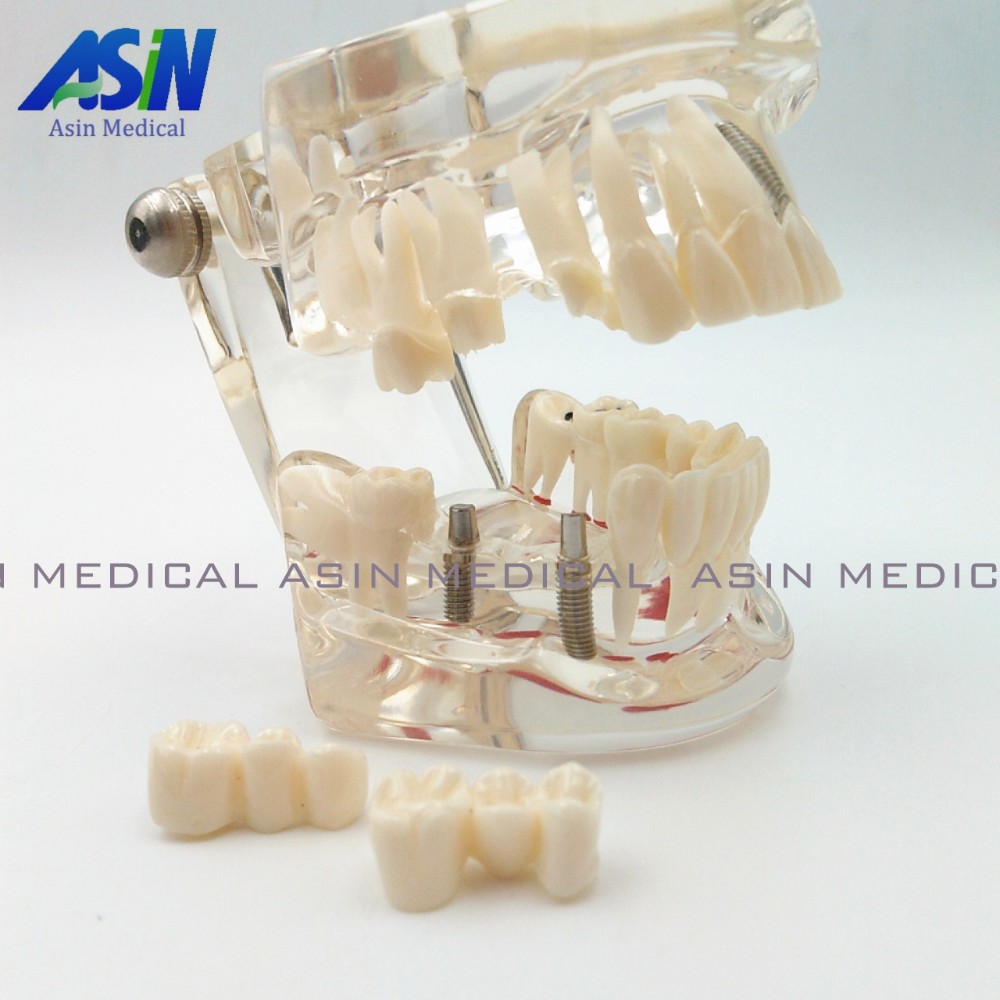 High Quality NEW arrival Dental implant Demonstration Bracket Simulation Caries Teeth Model teeth removable Dentist us826
