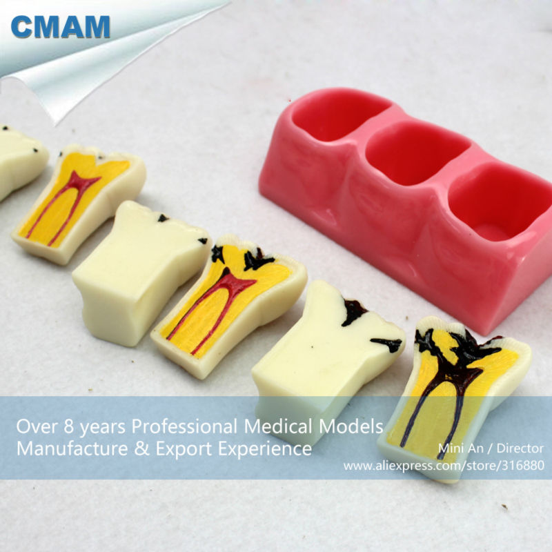 KQH-H387,4 times size caries demonstrating model(4xsize caries study model),Dental Model,Education,Medicine
