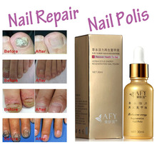 AFY Fungal Nail Treatment TCM Essence Oil Hand and Foot Whitening Toe Nail Fungus Removal Feet