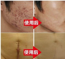 Nuobisong face care acne scar removal cream Acne Spots skin care treatment whitening face cream stretch marks moisturizing