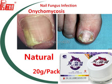 2 packs Nail fungus removal fungal nail infection Onychomycosis chinese herbs good restult
