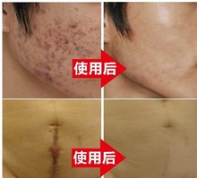 Original authentic   face care acne scar removal cream Acne Spots skin carewhitening face cream stretch marks moisturizing