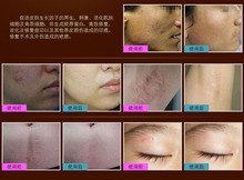 Hot Sale ginseng essence acne scar removal Face cream face care skin care treatment whitening cream