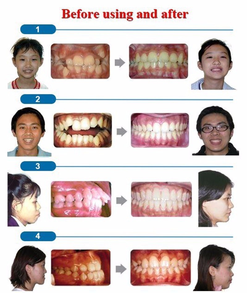 成人牙齿矫正器 隐形矫正牙套 矫正龅牙 保持器 夜间防磨牙儿童