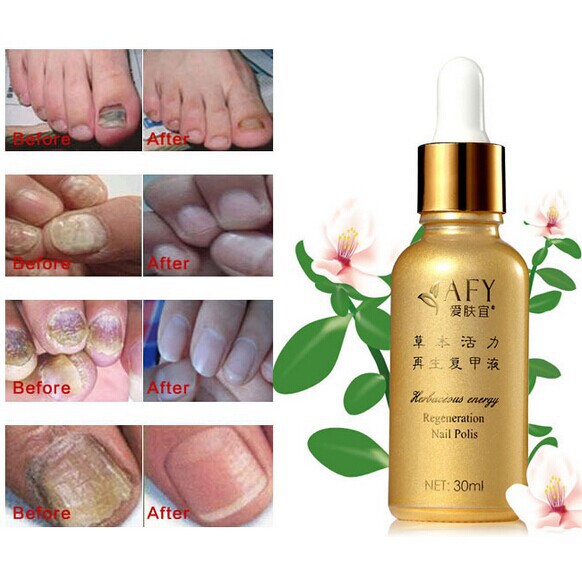 Fungal Nail Treatment Essence Oil TCM Hand Foot Toe Whitening Nail Fungus Removal Feet Care Nail