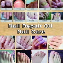 Snazii Nail Gel fungal nail oil essence 30ml treatment of onychomycosis nail repair nursing ringworm toe