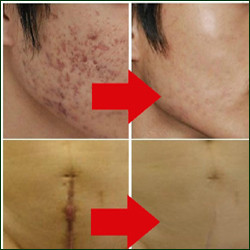 Nuobisong-face-care-acne-scar-removal-cream-Acne-Spots-skin-care-treatment-cream