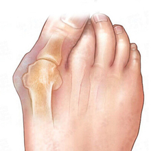 Sub toe toe braces Toe Separator Orthoses Beauty Health Braces foot care