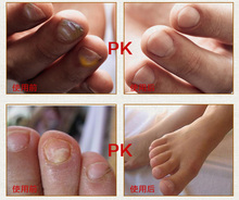 Hot sale Chinese medicine Fungal Nail Treatment Essence Nail and Foot Whitening Toe Nail Fungus Removal
