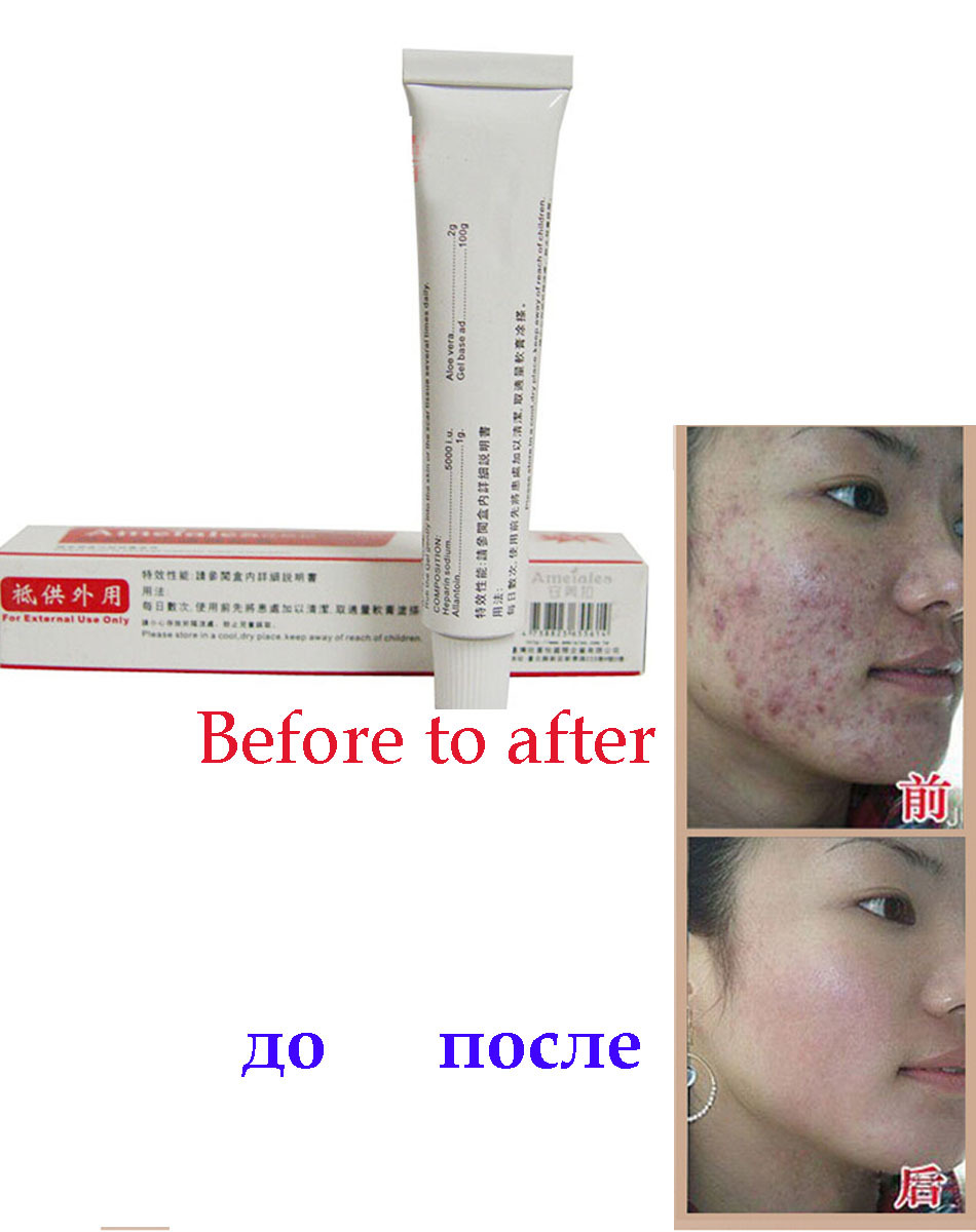 15g Womens fashon skin care acne scars removal cream face 15g Womens fashon skin care acne scars removal cream face
