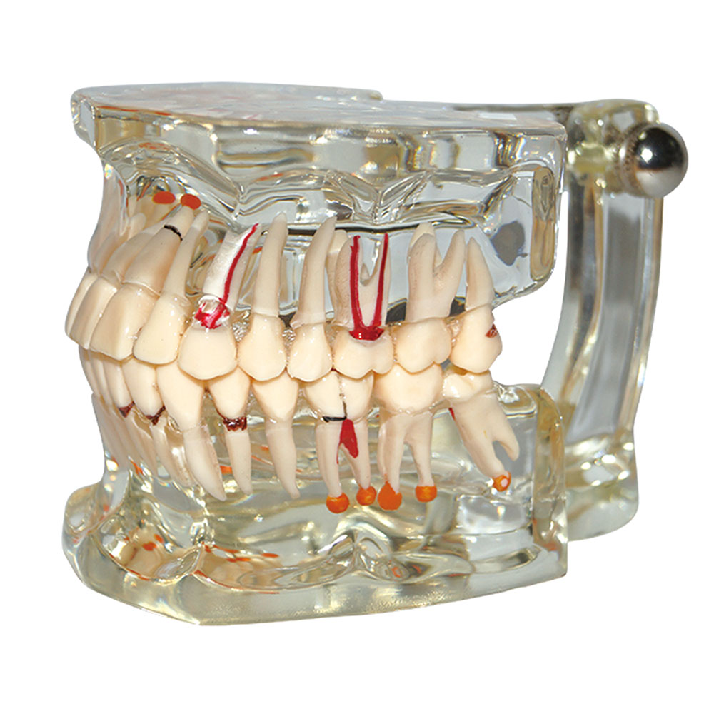 Dental Model Teeth Pathology Model With Half Implant Show Clearly the 