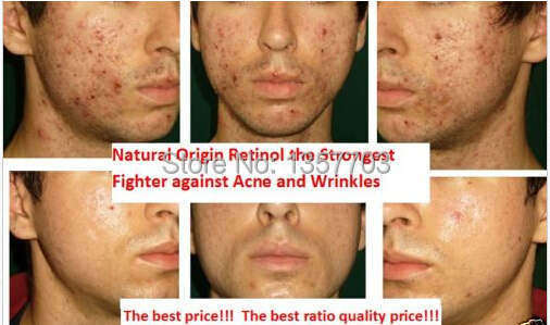 Compra retinol tratamiento del acné online al por mayor de Compra retinol tratamiento del acné online al por mayor de