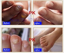2 PCS set Fungal Nail And Finger Nail Treatment Essence Nail and Foot Whitening Toe Nail