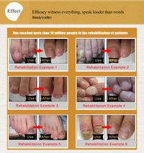 2Pcs A lot Liquid Nail Treatment Toe Pinceis Fungus Removal Essence for the treatment of nail
